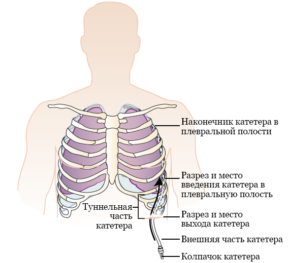Рисунок 2.&nbsp; Установка дренажного катетера PleurX