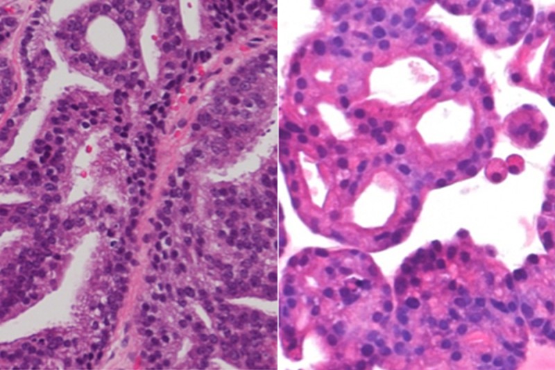 Stained pathology slides of a patient’s tumor (right) and of an organoid made from that tumor (left).