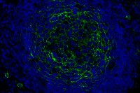 Human metastatic melanoma cells in a lymph node. ENPP1, a protein involved in immune evasion, is shown in green.