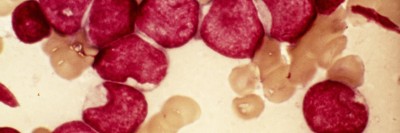 Leukemia cells