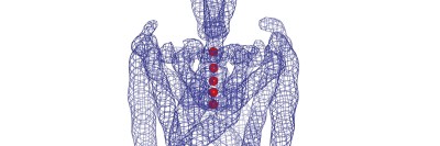 Pictured: Two mesothelioma cells connected by long extensions called tunneling nanotubes, which potentially may be a conduit for communication between the cells.