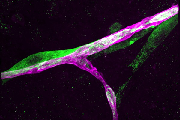 Pictured: A metastatic breast cancer cell (green) has infiltrated the brain and is holding on tightly to a blood capillary (purple).